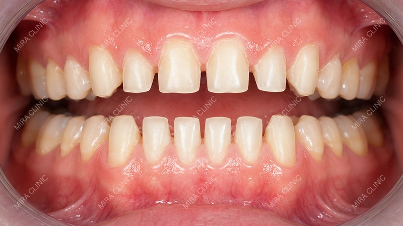 Veneers tooth preparation